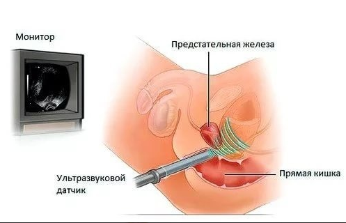 ТРУЗИ предстательной железы