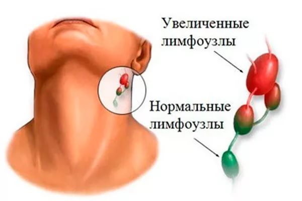 Увеличение лимфоузлов